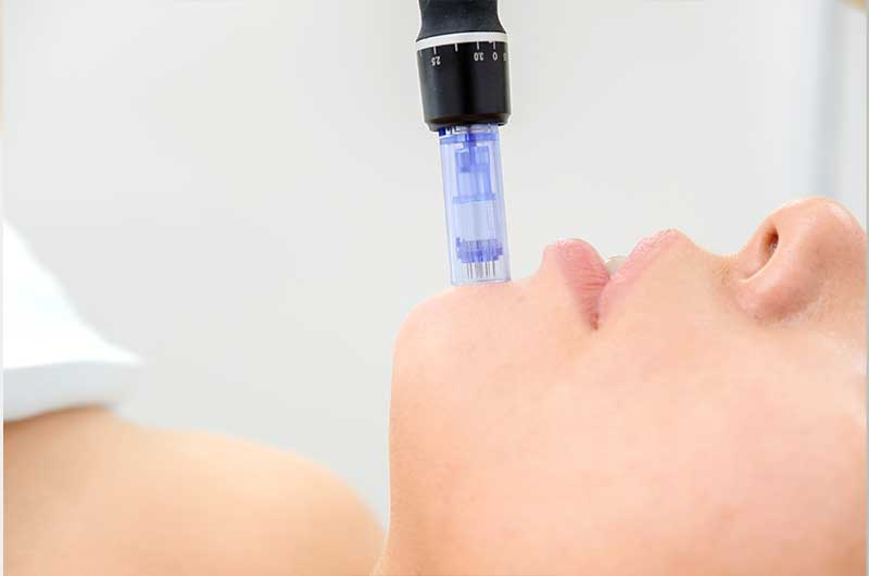 Dermapen - Mezoterapi